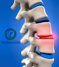 Slider image (10) MexStemCells Clinic